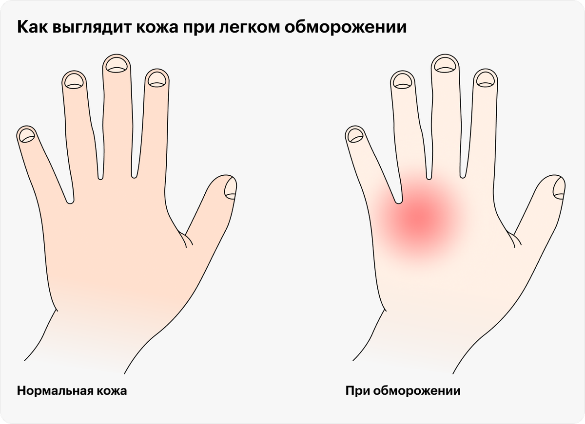 Как выглядит кожа после обморожения Первая помощь при обморожении. Тайминг в описании. смотреть видео онлайн от "Д