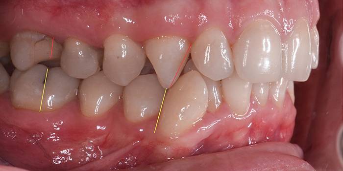 Вид зубов сбоку. С помощью желтых и красных линий врач объясняла, что с зубами не так и в какую сторону их будут двигать