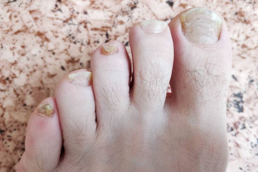 Так выглядели мои ногти 18 мая 2018 года — до начала лечения у врача. Сделал эти фото специально, чтобы потом отслеживать прогресс