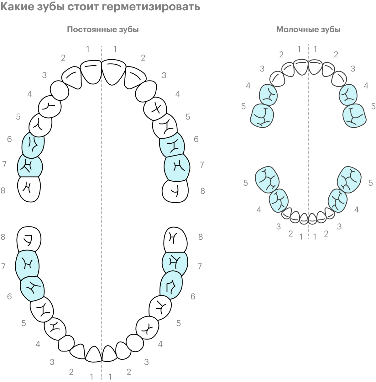 Герметизация обычно нужна постоянным «шестеркам» и «семеркам». Иногда герметизируют и молочные зубы — 5 и 4