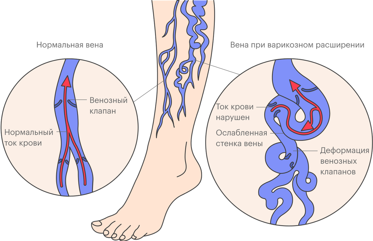 Вены нижних конечностей варикозное расширение. Варикозное расширение вен клапаны. Варикозное расширение вен причины. Варикозное расширение вен кровотечение.