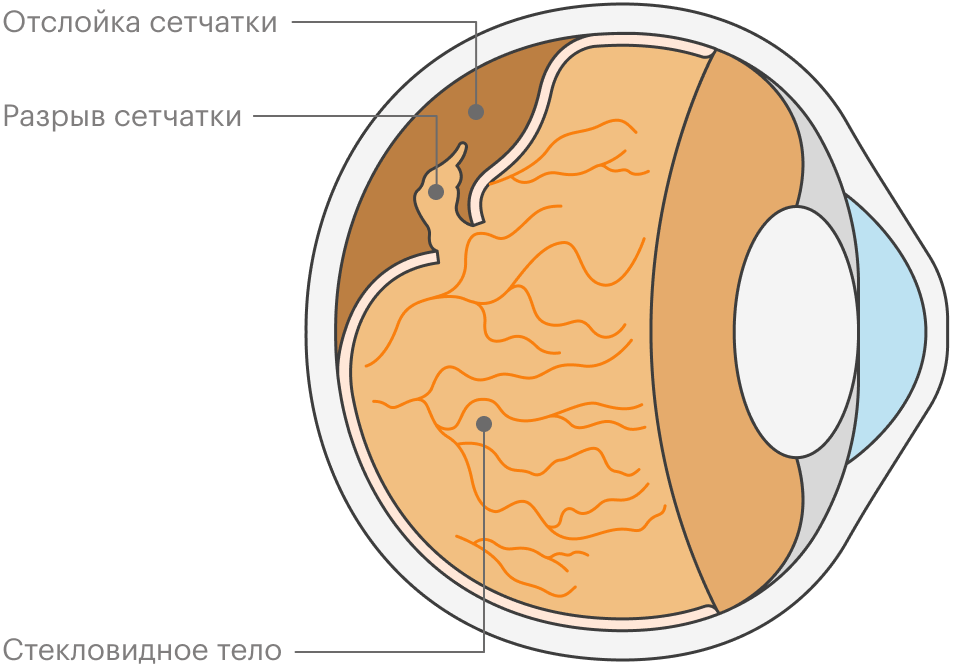 Отслойка сетчатки глаза: симптомы, диагностика, лечение, как проходит ...