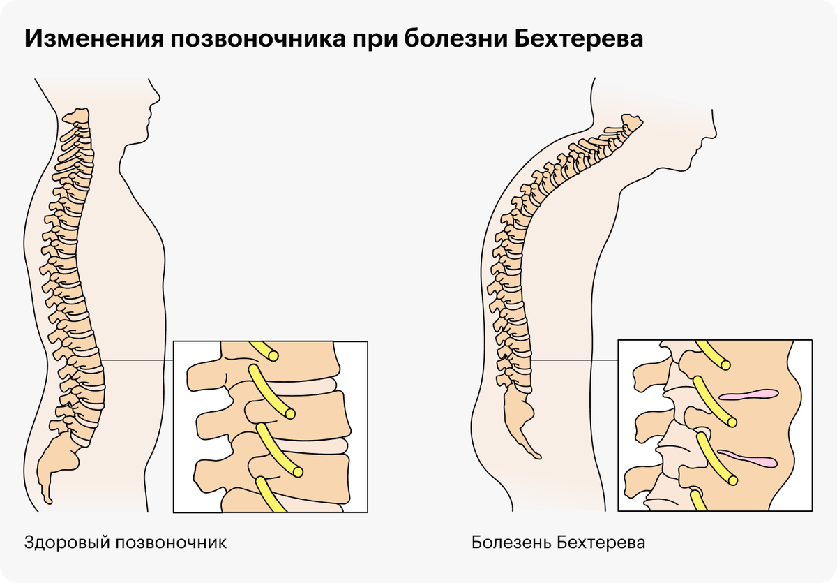 Болезнь бехтерева фото больных