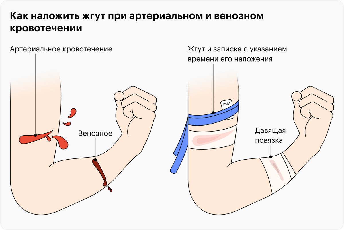 Виды кровотечений признаки способы остановки