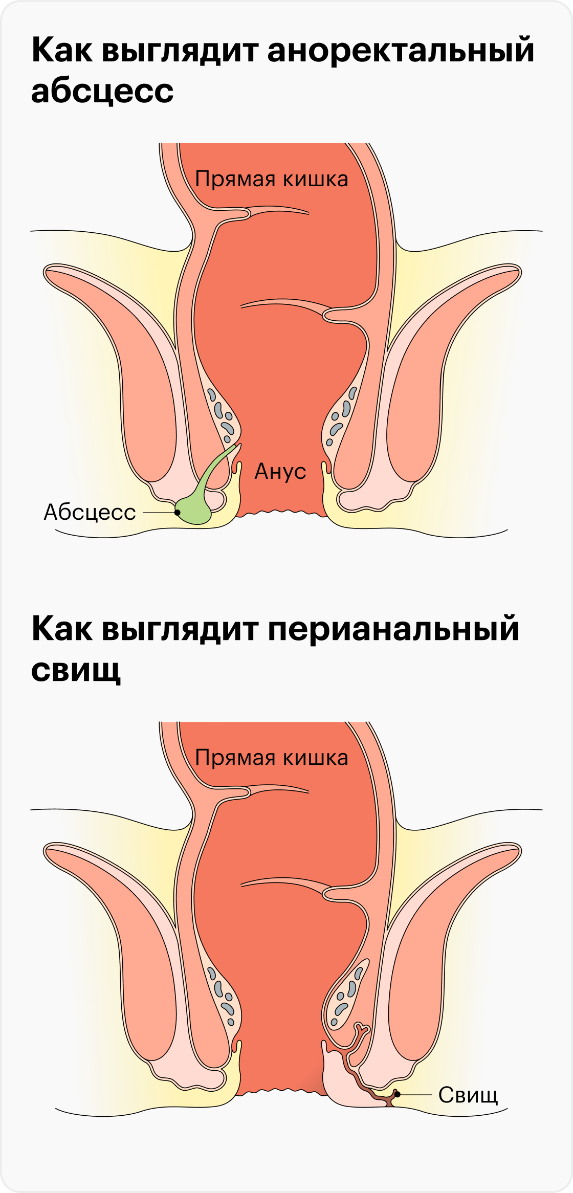 Анальная трещина лечение дома