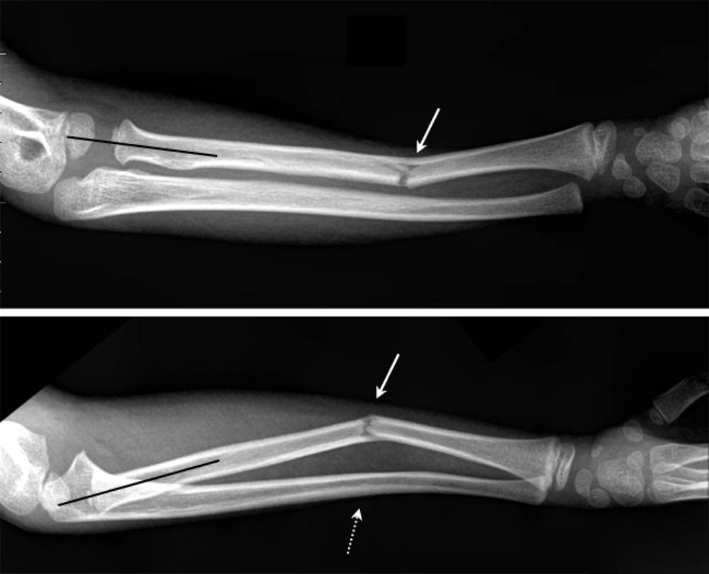 Перелом лучевой кости и пластическая деформация локтевой: из-за повышенной гибкости детские кости часто изгибаются, но не ломаются. Источник: learningradiology.com