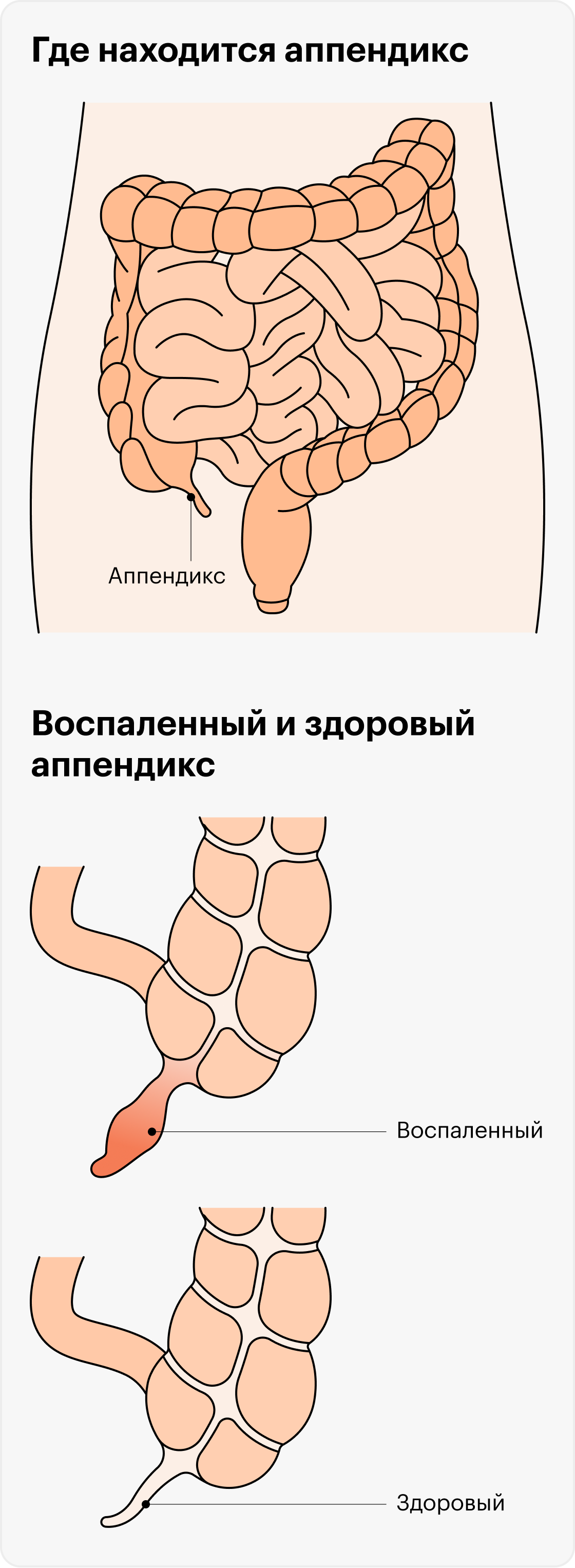 Аппендицит: симптомы, признаки, с какой стороны болит, операция по ...