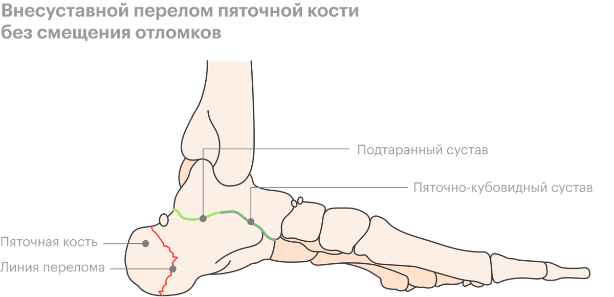 Перелом пяточной кости сколько заживает