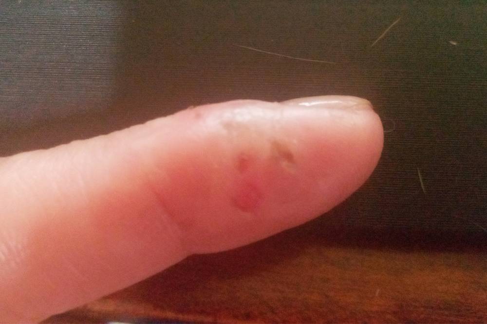 Так выглядит мой указательный палец, когда дерматофагия возвращается