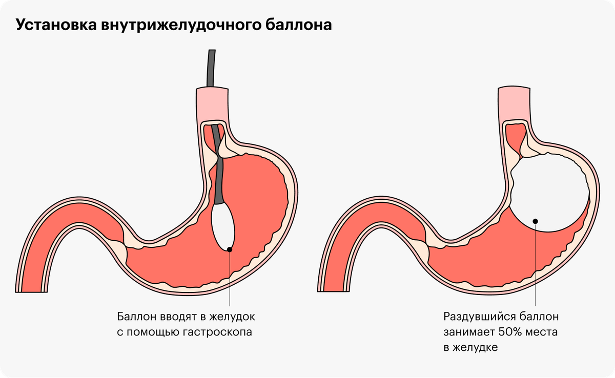 операции в бариатрической хирургии. где сделать бариатрическую операцию. где сделать бариатрическую операцию. где сделать бариатрическую операцию. бариатрическая хирургия.