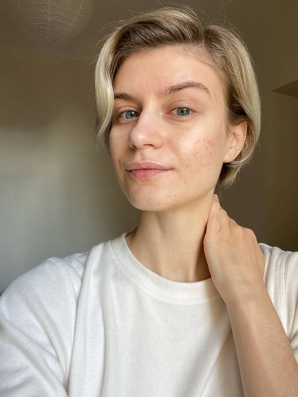 Акне у взрослых: лечение препаратами, анализы, какие продукты можно и ...