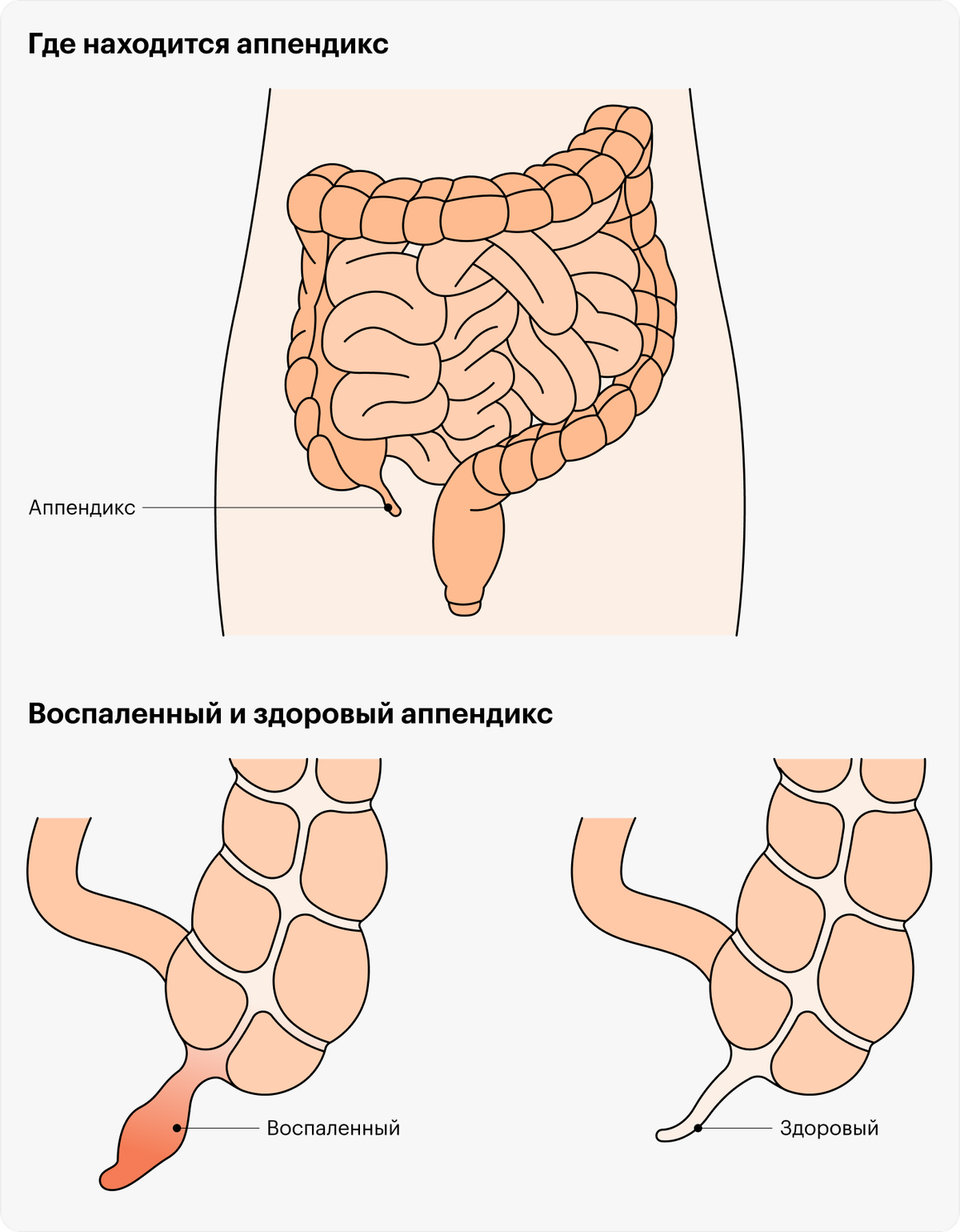 Аппендикс с какой стороны фото