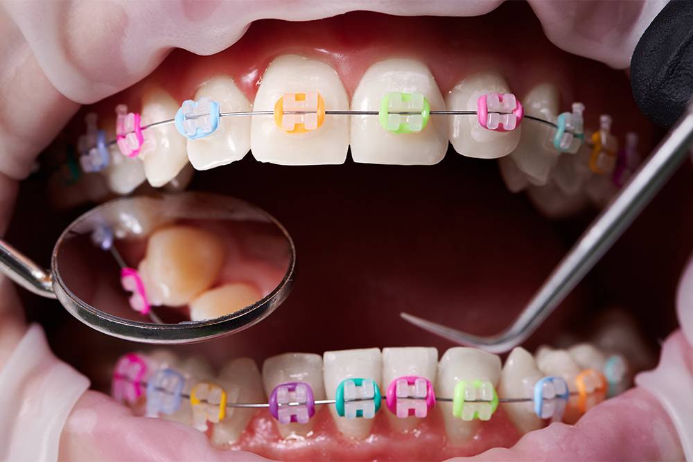 Cual es el ultimo arco en ortodoncia