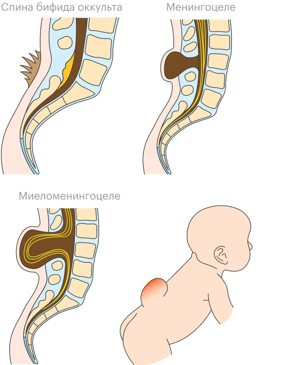 Расщелина позвоночника. Расщелина позвоночника (spina Bifida). Спина бифида менингоцеле.