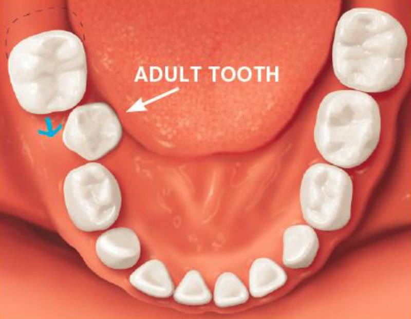 Пунктирная линия обозначает «законное» место молочного зуба, а&nbsp;синяя стрелка — место, не&nbsp;которое он смещается из-за&nbsp;преждевременного выпадения молочного зуба. В итоге постоянному зубу может не&nbsp;хватить места на&nbsp;челюсти. Источник:&nbsp;specialtydentist.com