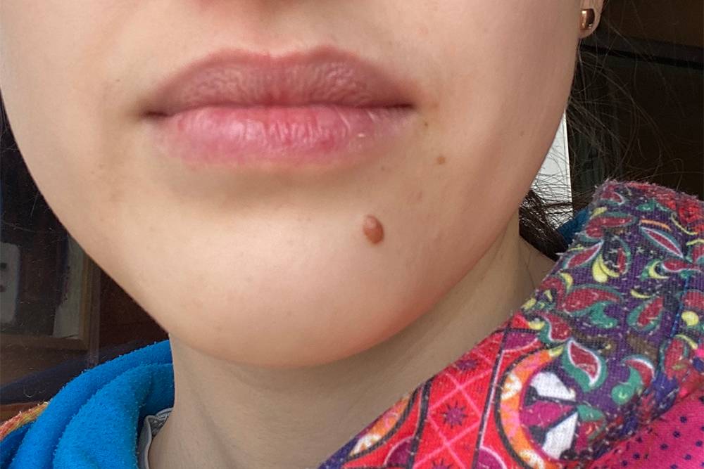 Так выглядел мой подбородок до удаления родинки