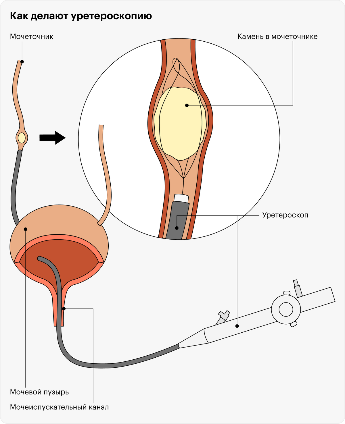 При&nbsp;уретероскопии камень удаляют или разрушают с помощью эндоскопического прибора, который вводят через мочеиспускательный канал