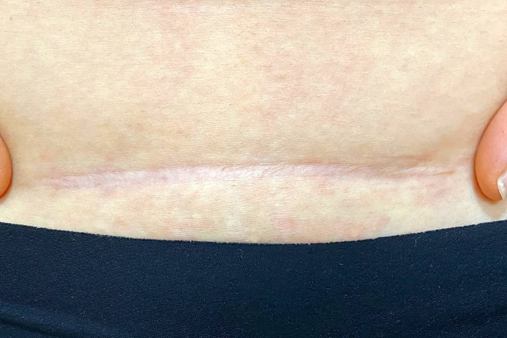 Кесарево сечение: показания, как делают, на каком сроке делают плановое ...