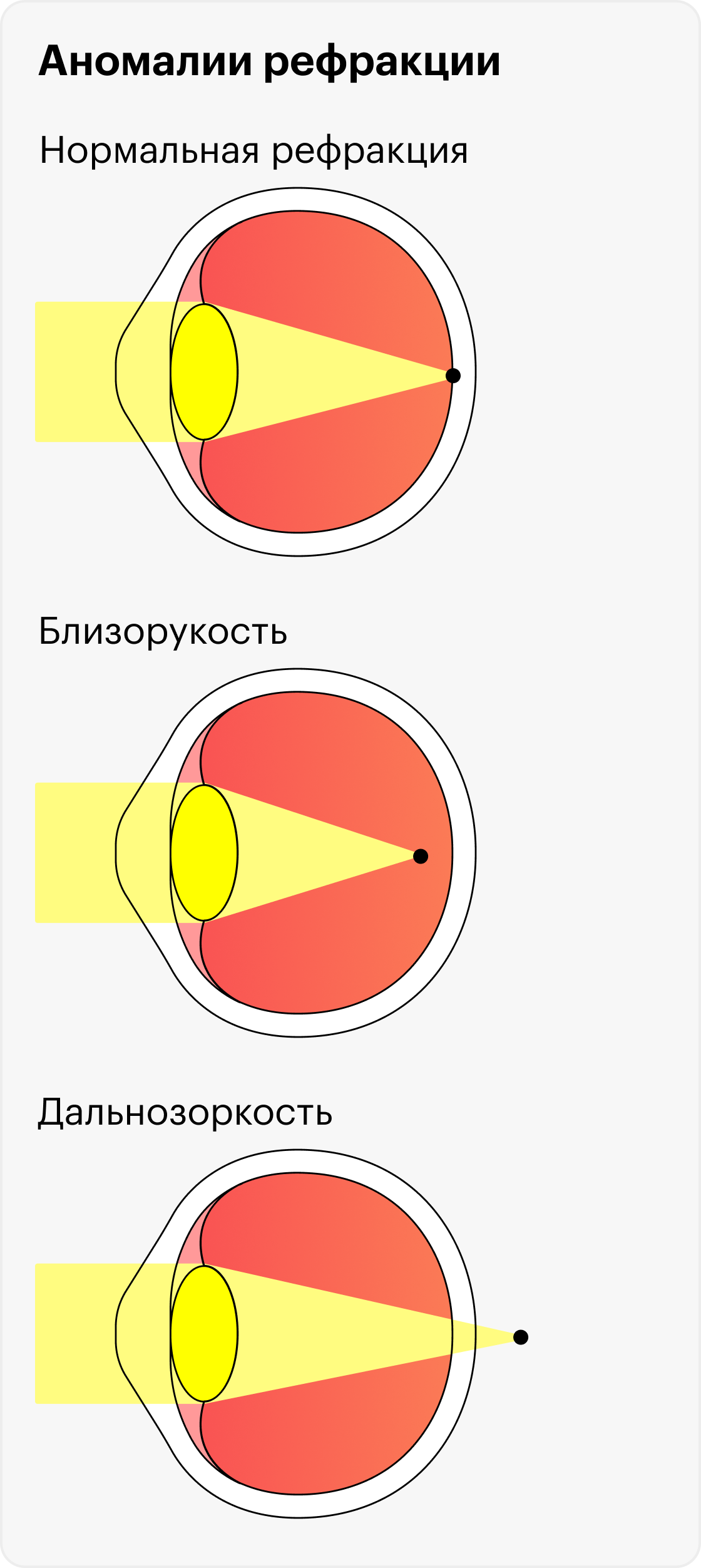 При близорукости изображение фокусируется