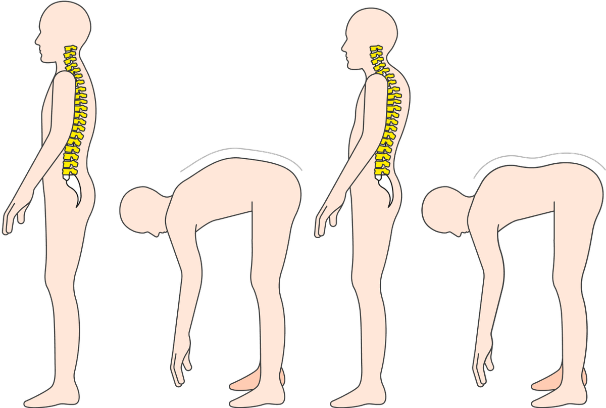 Сколиоз в картинках