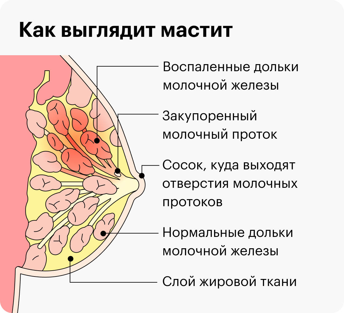 воспалилась одна грудь при грудном вскармливании фото 7