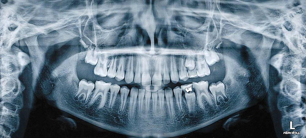 Снимок, на котором видна пломба на «пятерке» и два молочных зуба, которым было пора на выход