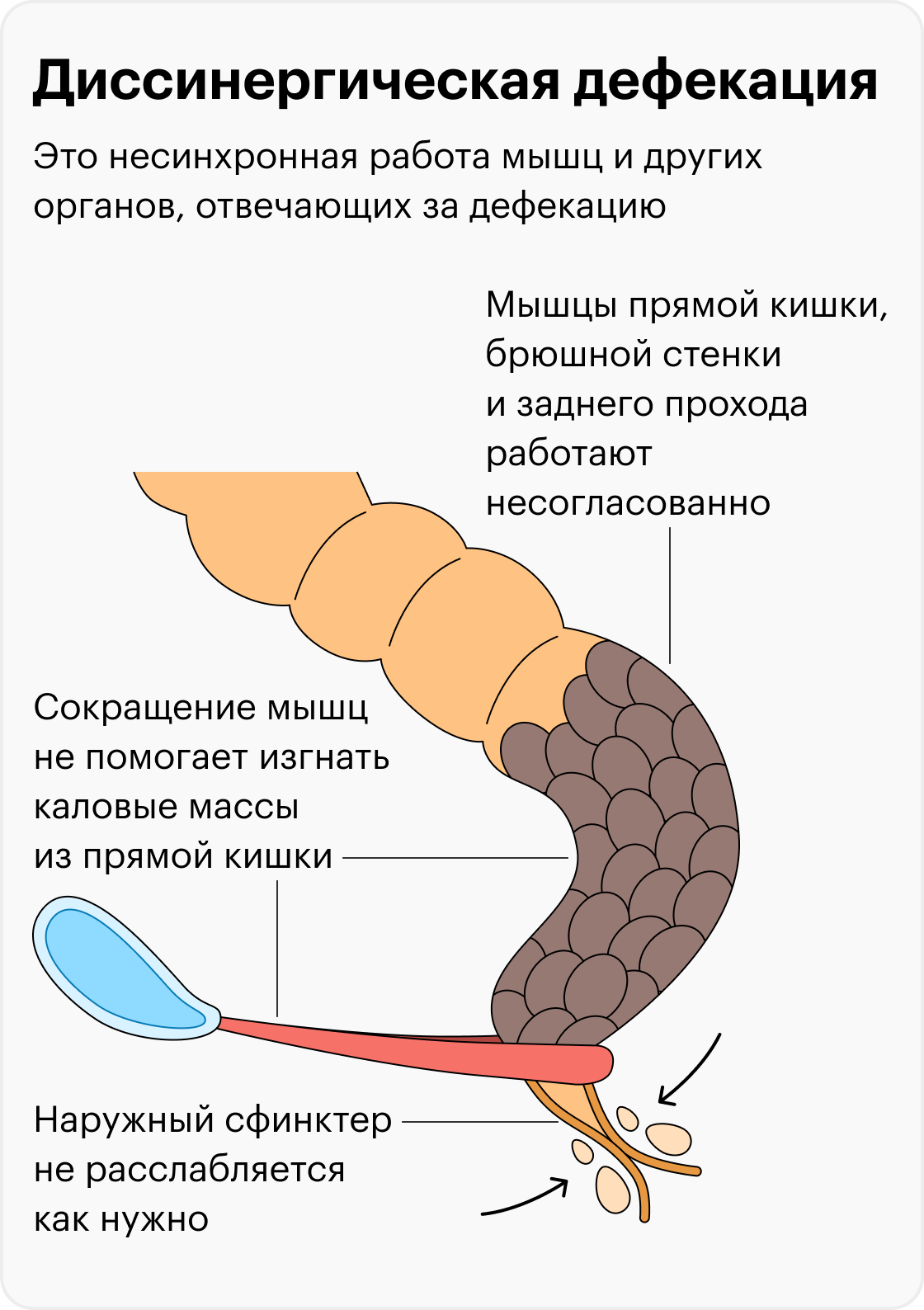 При дефекации идет. Сфинктер при дефекации. Продукты для дефекации. Пособие при дефекации.