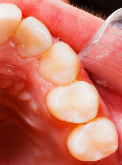 Зуб после пломбирования композитной смолой. Фото:&nbsp;Lighthunter / Shutterstock