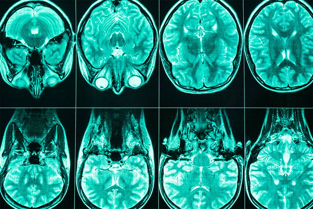 Магнитно-резонансная томография позволяет детально изучить мягкие ткани организма. Но делать ее без показаний не стоит. Источник: Jalisko / Shutterstock