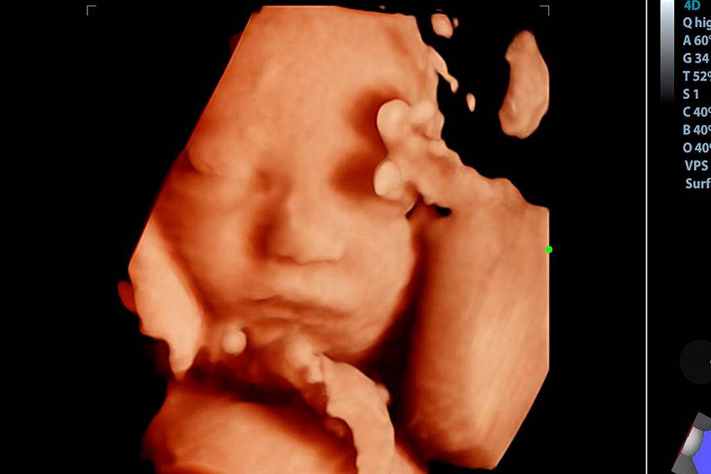 На 3Д-УЗИ изображение будет объемным, получится разглядеть примерные черты лица малыша. Лучше делать такое УЗИ в&nbsp;25–30&nbsp;недель. Источник: whitetherock photo / Shutterstock