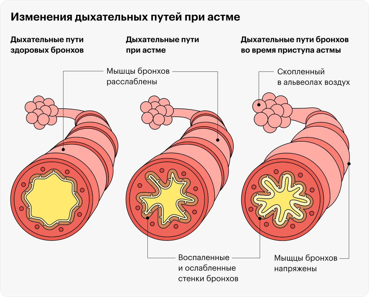 Бронхиальная астма: приступы, симптомы, диагностика, лечение болезни ...