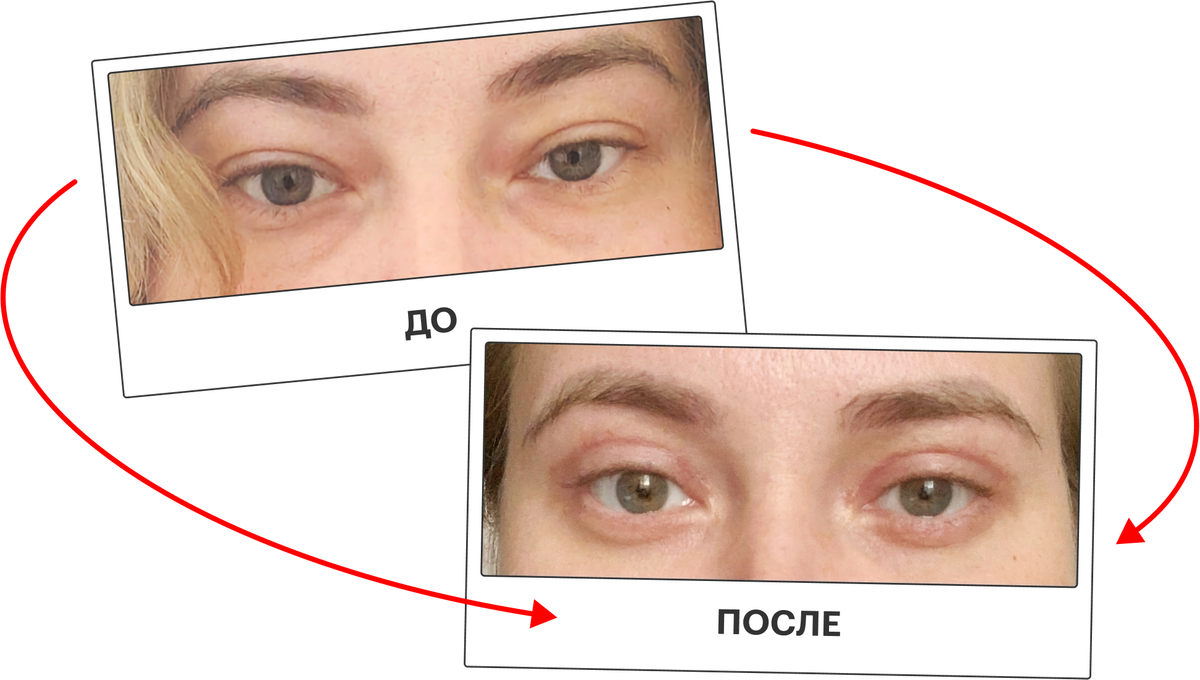 Реабилитация после блефаропластики: основные принципы и рекомендации