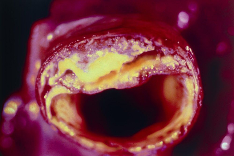 Так выглядит атеросклеротическая бляшка в просвете сосуда. Источник: Справочник MSD