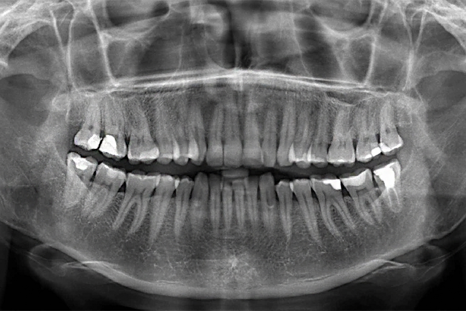 Панорамный снимок зубов выглядит так. Источник: medi.spb.ru