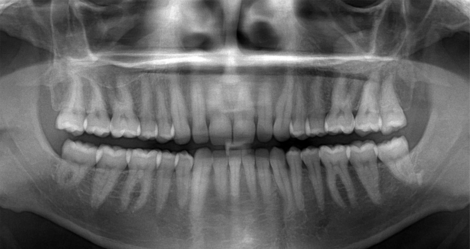 Панорамный снимок зубов выглядит так. Источник: nava-mos.ru
