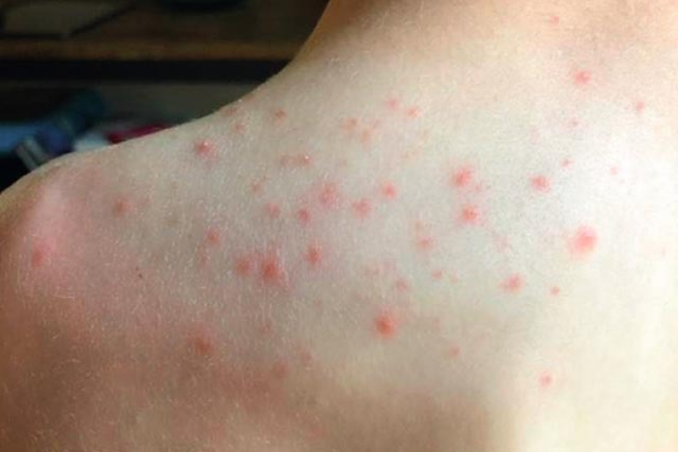 Папулы на коже плеча при зуде пловца. Источник: dermnetnz.org