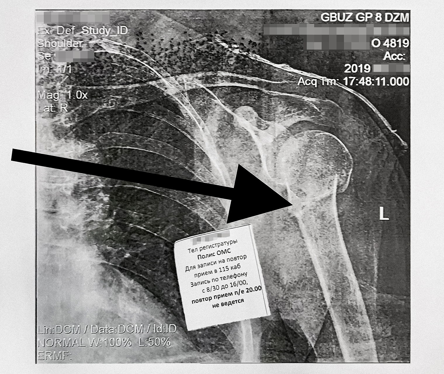 Рентгеновский снимок, где хорошо видно перелом
