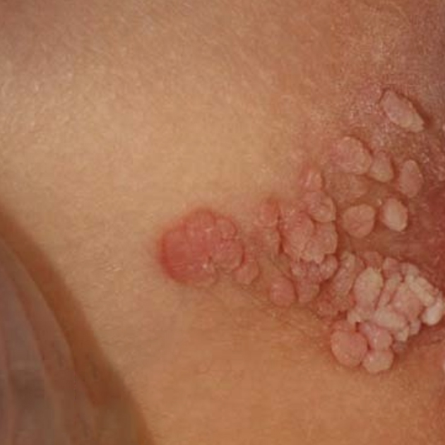 Так выглядят аногенитальные бородавки. Источник: dermnetnz.org