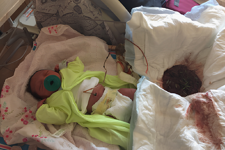 Младенец с плацентой после лотосовых родов. Источник: journals.sagepub.com