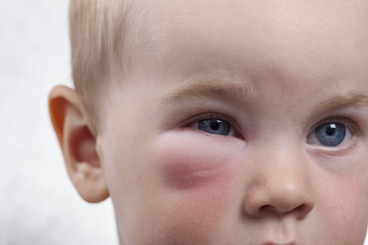 От укуса мошки у людей может воспалиться участок кожи, образоваться отек и даже заплыть глаз. Фотография: OMfotovideocontent / Shutterstock / FOTODOM