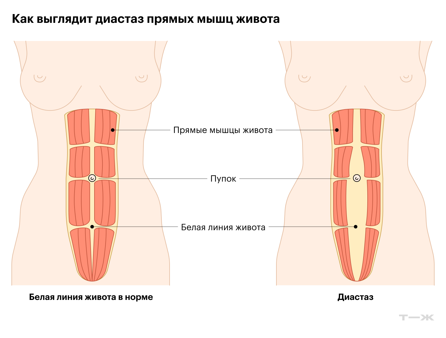 При лишнем весе и ожирении передняя брюшная стенка растягивается изнутри, так возникает расхождение прямых мышц — диастаз. Чаще всего его выявляют после того, как человек сбросил вес