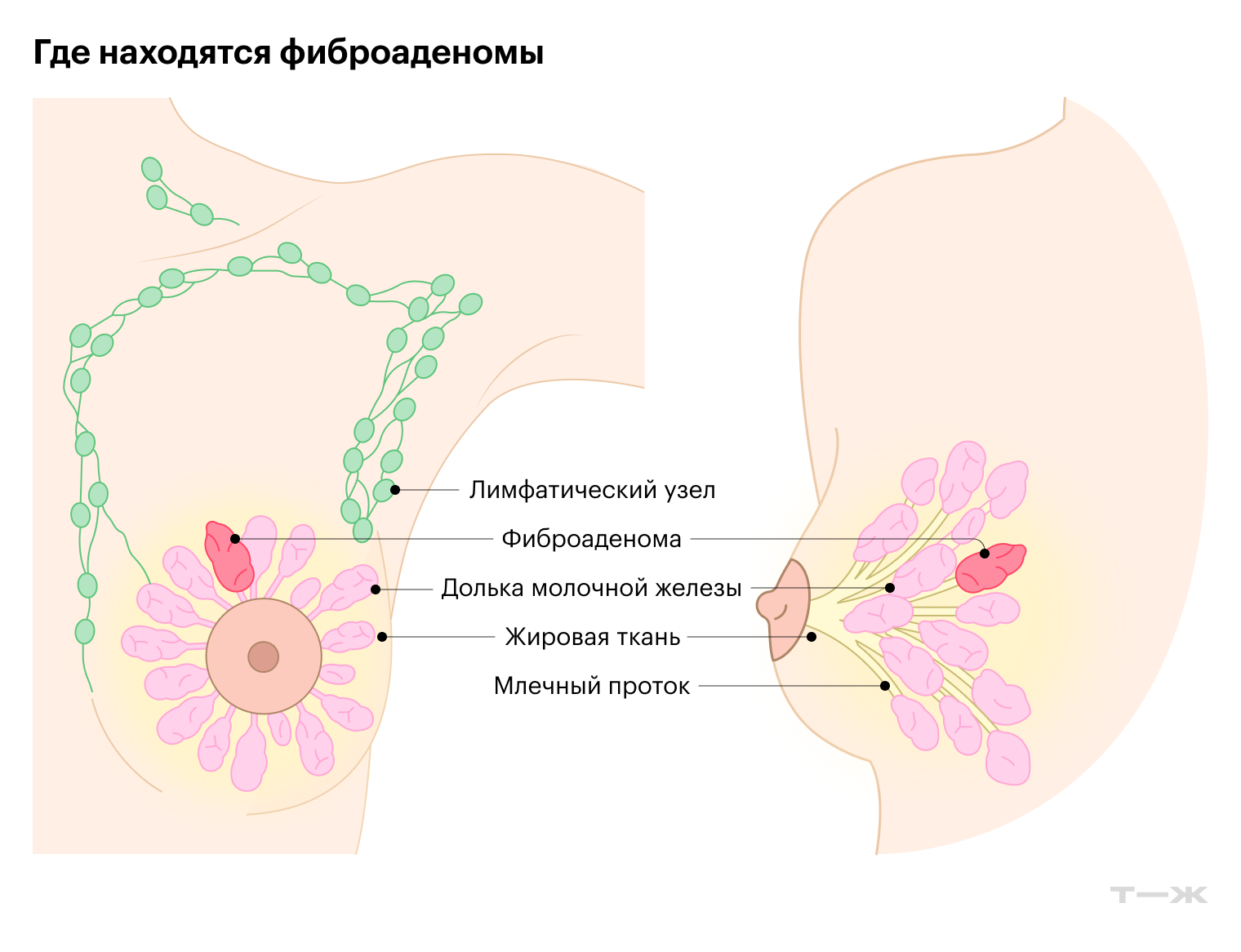 Фиброаденомы развиваются из долек молочной железы