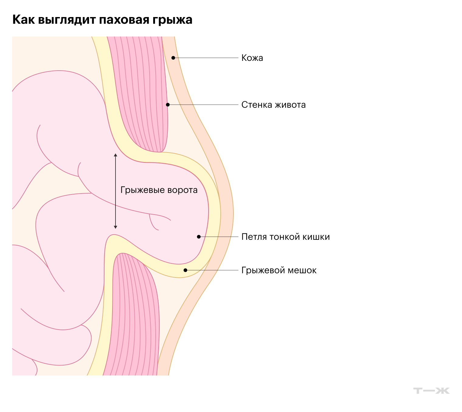Паховая грыжа возникает, когда содержимое брюшной полости выходит под кожу через слабый участок брюшной стенки в области паха
