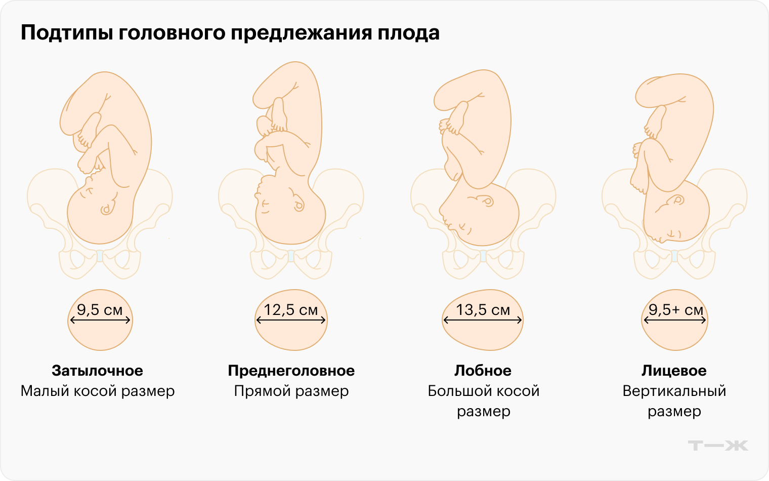 При затылочном предлежании головка ребенка проходит через родовые пути в самом компактном размере — 9,5 см, а при разгибательных вариантах — уже 12—13,5 см. Именно поэтому такие роды считаются сложнее и чаще требуют вмешательств