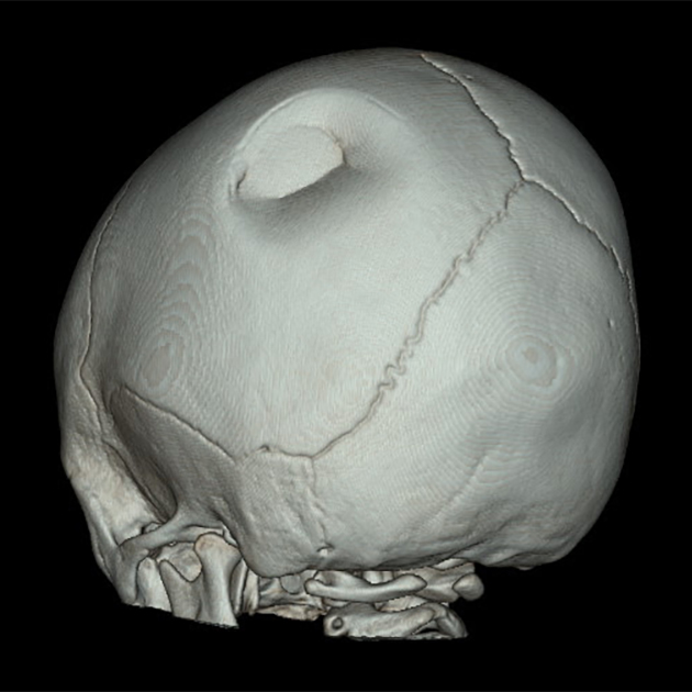 Перелом левой теменной кости по типу ping⁠-⁠pong на КТ. Источник: medicine.uams.edu