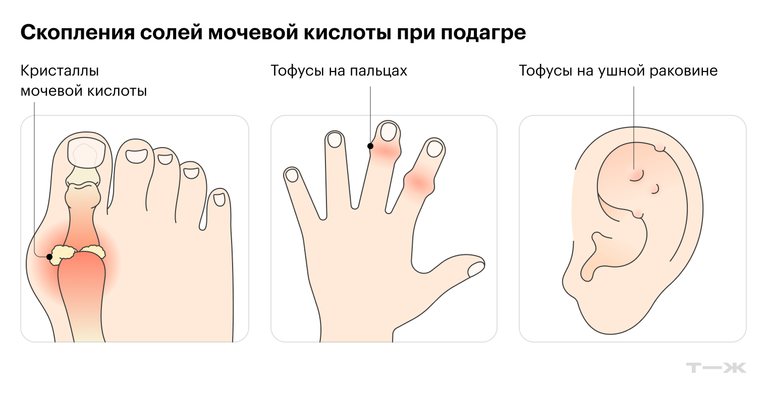 При подагре кристаллы моноурата натрия обычно откладываются в суставах. Со временем появляются тофусы — плотные узелки размером до нескольких сантиметров