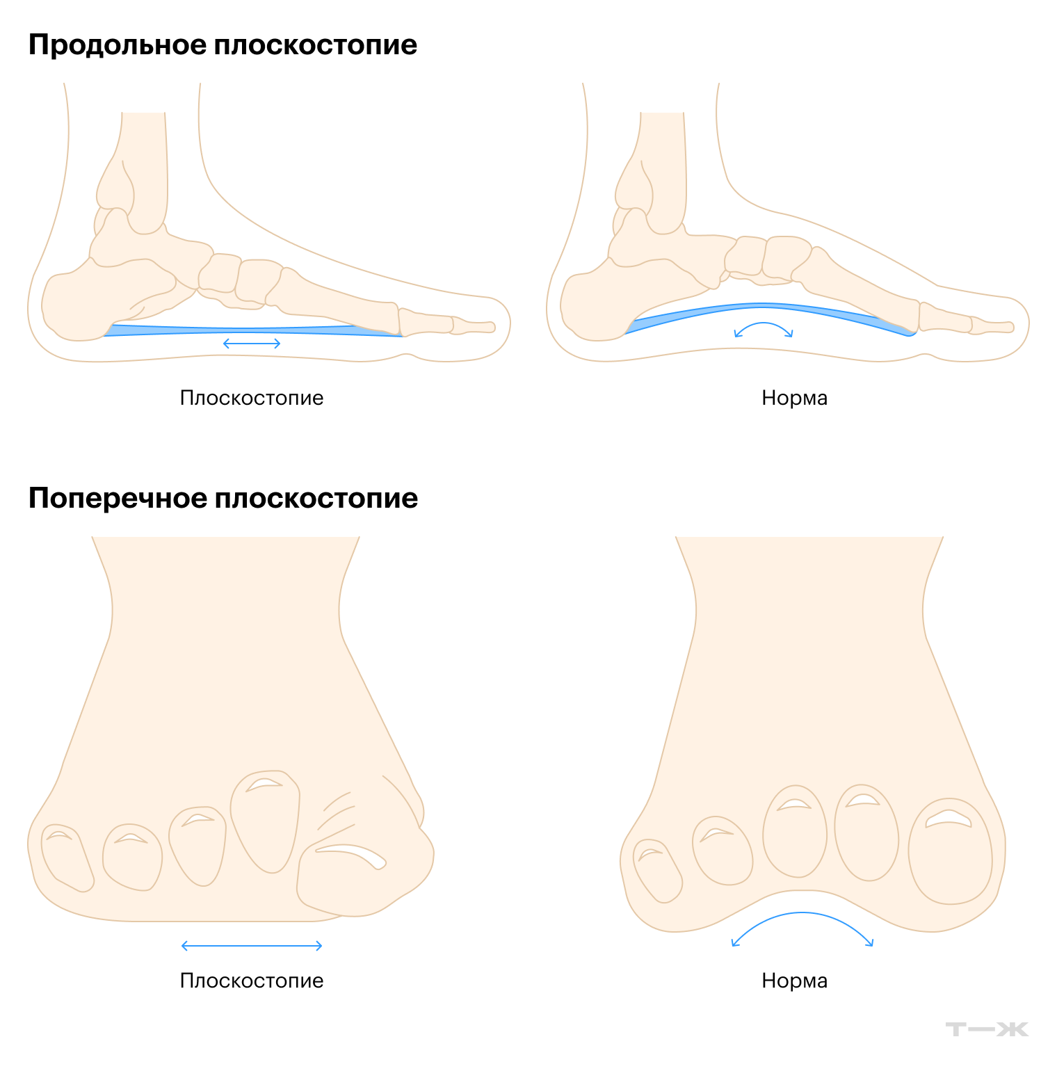 Плоскостопие принято делить на продольное — когда снижается продольный свод и стопа касается пола почти всей подошвой, поперечное — когда опускается поперечный свод и передний отдел расширяется, и комбинированное — когда есть обе особенности