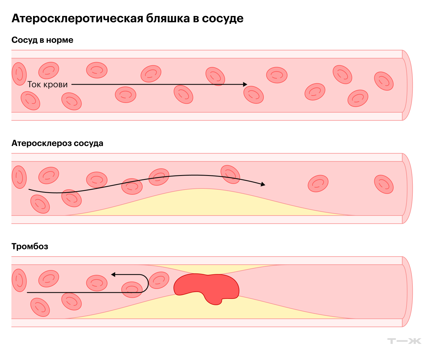 Атеросклеротические бляшки могут разрушаться — тогда содержимое попадает в кровь, что приводит к тромбозу