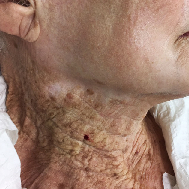 Фотография 92-летней женщины, которая более 40 лет наносила крем с SPF на лицо, но не использовала его для шеи. Источник: onlinelibrary.wiley.com