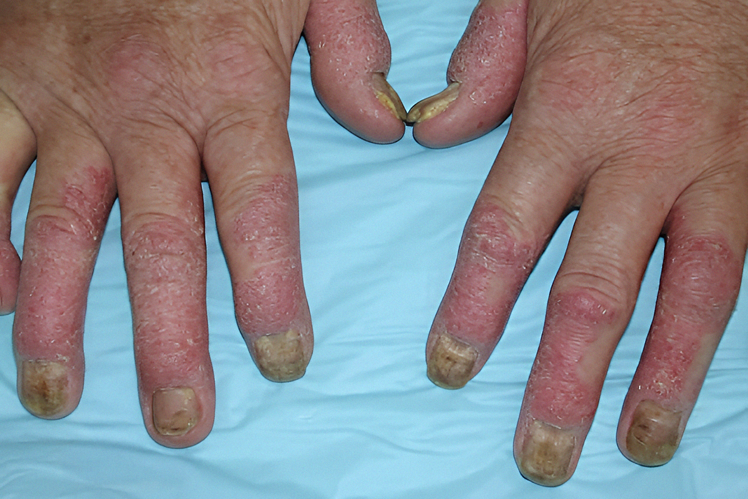 Поражение ногтей возникает у 90% пациентов с псориатическим артритом. © dermnetnz.org